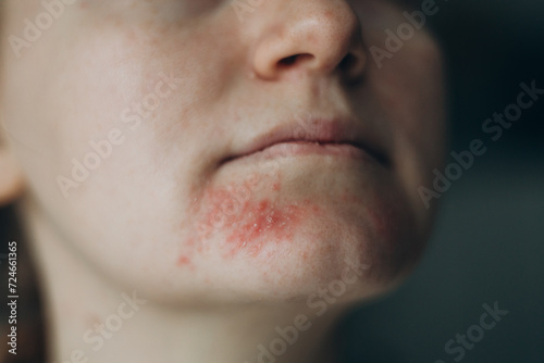 Perioral dermatitis on woman face. Closeup dermatitis on skin, ill allergic rash eczema skin of patient, atopic dermatitis symptom skin detail texture. The concept dermatology photo