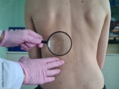 Dermatologist examines mole on back using magnifying glass