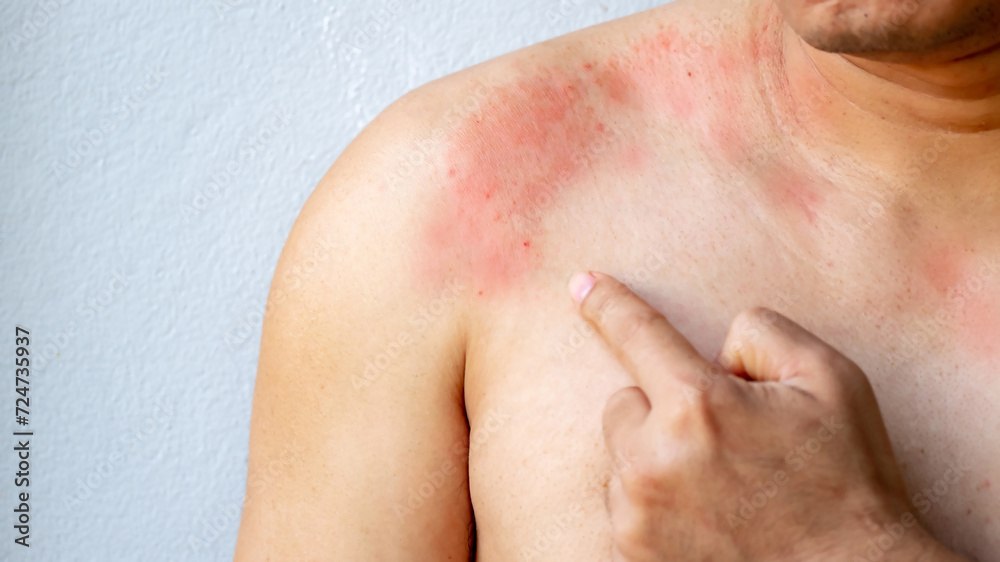 man poiting with itchy skin on the body on the chest or shoulde