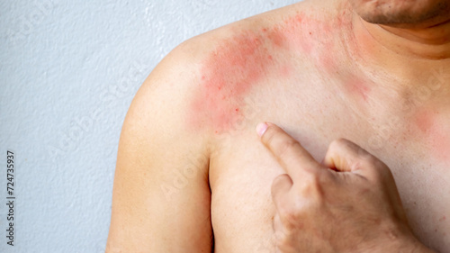 man poiting with itchy skin on the body on the chest or shoulde  itching due to rash  fungus  allergy  dermatological disease  dry skin. Healthcare and medical concept.