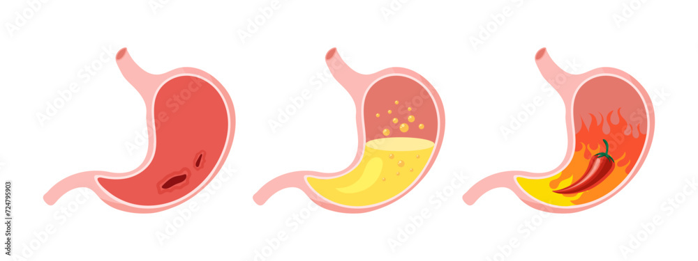 Unhealthy human stomach, medical icons set. Gastritis, ulcer, stomach pain, bloating. Anatomy of the digestive system. Vector