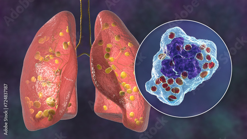 Lung histoplasmosis, 3D illustration photo