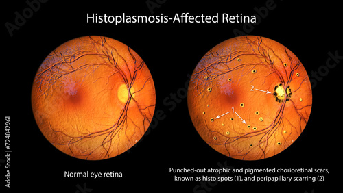 Retina in Ocular Histoplasmosis Syndrome, 3D illustration photo