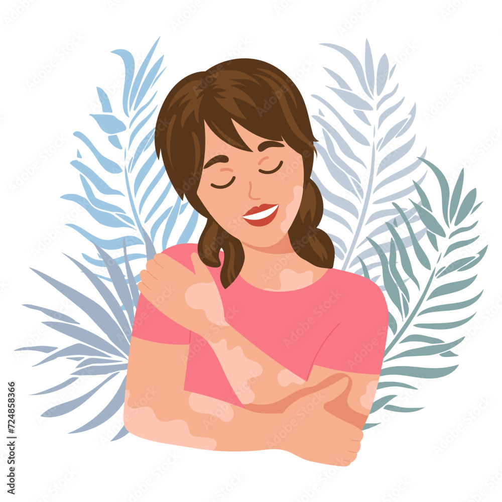 World vitiligo day, awareness banner. Cute woman with vitiligo disease on tropical leaves background. Banner, poster, vector World vitiligo day, awareness banner. Cute woman with vitiligo disease on tropical leaves background. Banner, poster, vector