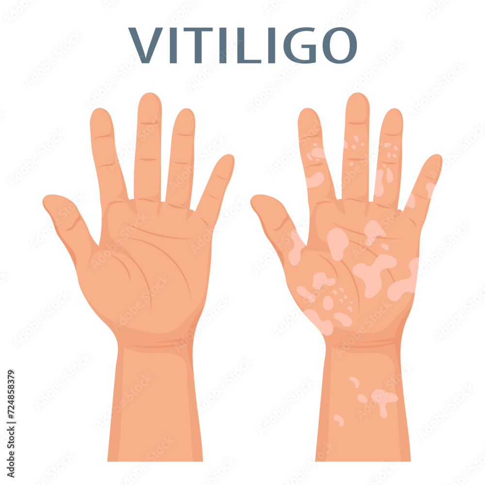 Hands with dermatological disease vitiligo. Medicine concept. Banner, poster, vector Hands with dermatological disease vitiligo. Medicine concept. Banner, poster, vector