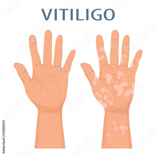 Hands with dermatological disease vitiligo. Medicine concept. Banner, poster, vector