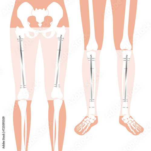 internal nail in an adult femur