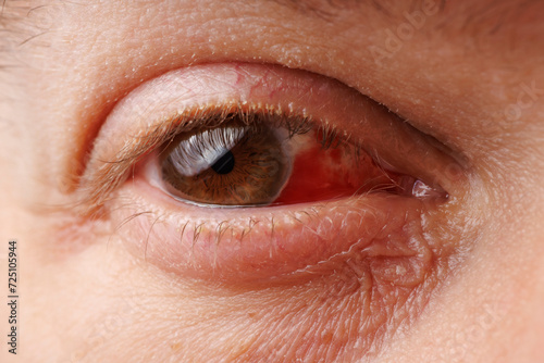Gros plan d'un oeil avec une hémorragie sous conjonctivale