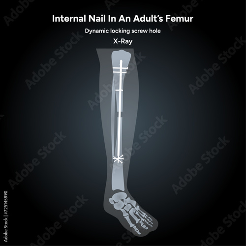 internal nail in an adult femur x-ray