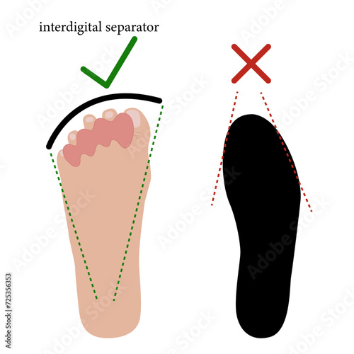 Interdigital separator, toe corrector, silicone
Used for calluses and corns, finger deformities, arthrosis, arthritis, gout, vascular disorders, pain in the finger joints. Vector illustration 
