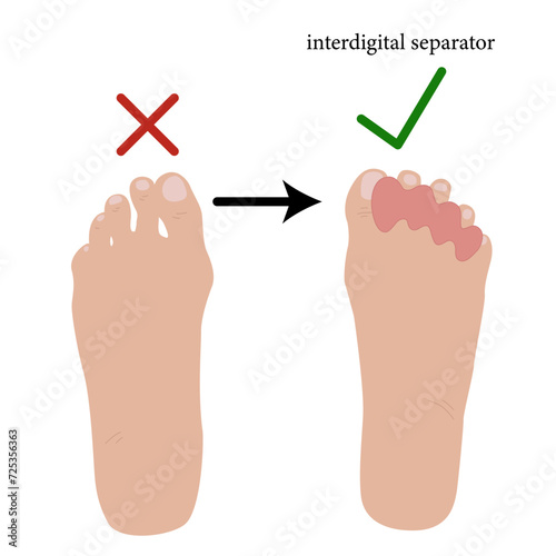 Interdigital separator, toe corrector, silicone
Used for calluses and corns, finger deformities, arthrosis, arthritis, gout, vascular disorders, pain in the finger joints. Vector illustration 
 photo