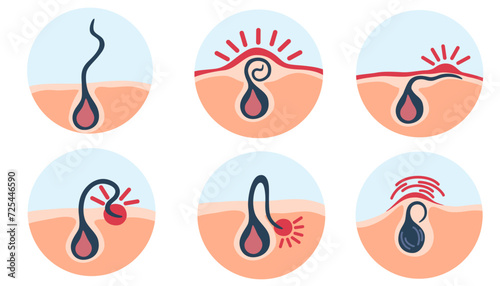 Ingrown hair. Hair has grown back into the skin surface after shaving. Inflamed follicle. Shaving concept. Vector illustration with problems after depilation.