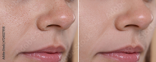 Blackhead treatment, before and after. Collage with photos of woman, closeup view photo