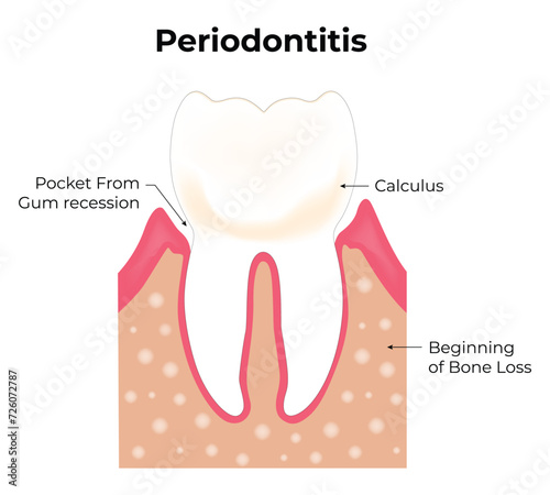 Periodontitis Science Design Vector Illustration Diagram
