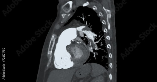 CTA pulmonary artery is a non-invasive imaging technique, providing detailed visuals of the pulmonary blood vessels in study case Showing A pulmonary embolism . photo