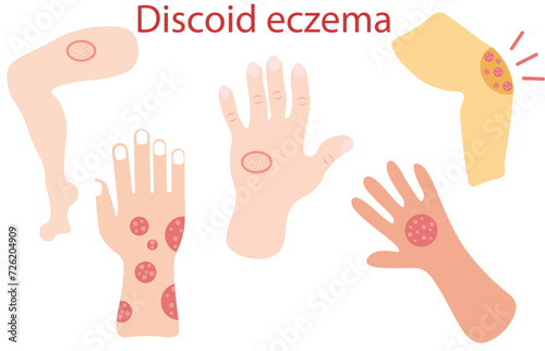Discoid eczema,Nummular dermatitis. Discoid eczema is a chronic skin condition that causes skin to become itchy, swollen and cracked in circular or oval patches,Close-up of a Human's hand ,five photo