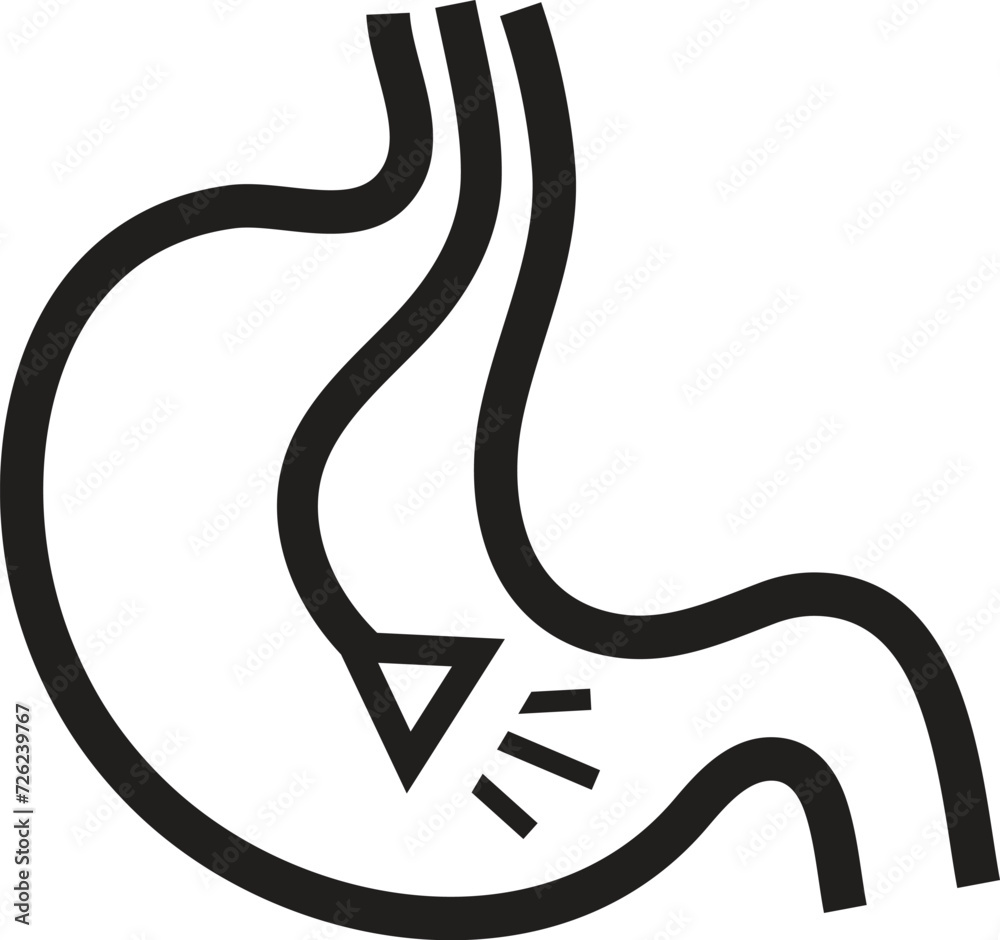 Gastric balloon weight loss. Installation of a gastric balloon into