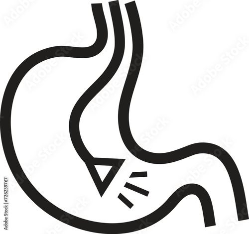 Gastric balloon weight loss. Installation of a gastric balloon into stomach. Methods of weight loss surgery. Human anatomy.