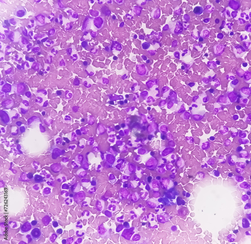 Photomicrograph of Bone marrow study showing Megakaryocytic Hyperplasia photo