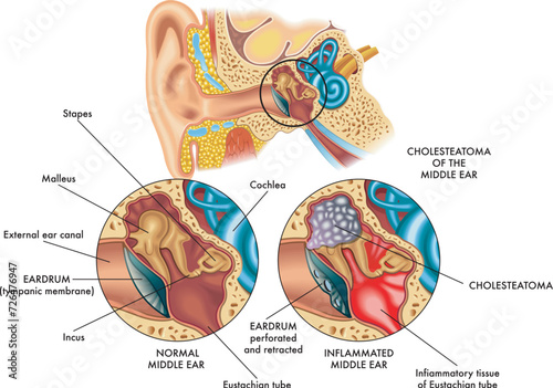 Medical illustration comparing the internal part of the ear (middle ear) on the left healthy and on the right affected by cholesteatoma, with annotations.