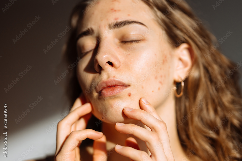 Young woman touching a pimple on her face, feeling annoyed because of problems with skin. Dermatology, cosmetology, skin care. Young woman touching a pimple on her face, feeling annoyed because of problems with skin. Dermatology, cosmetology, skin care.