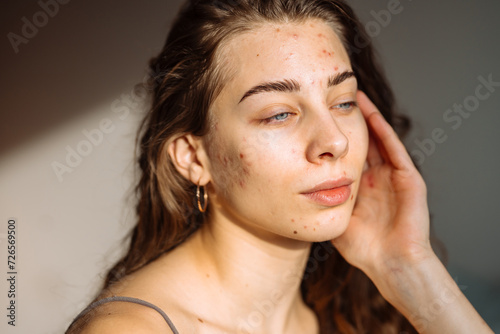 Young woman touching a pimple on her face, feeling annoyed because of problems with skin. Dermatology, cosmetology, skin care.