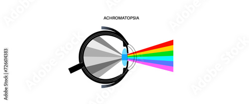 Achromatopsia vision deficiency