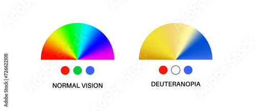 Deuteranomaly and deuteranopia