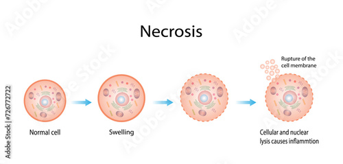 Necrosis, Pathologic Cell Death, Death of the body tissues, Cell injury which results in the premature death of cells in living tissue by autolysis.