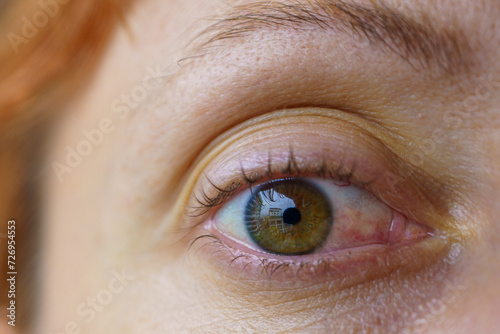 Caucasian Woman's Eye with Symptoms Similar to Pinguecula, Scleritis, Ocular Surface Squamous Neoplasia (OSSN) photo