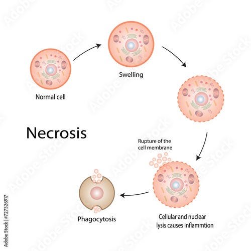 Necrosis, Pathologic Cell Death, Death of the body tissues, Cell injury which results in the premature death of cells in living tissue by autolysis. Vector illustration.