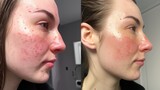 Rosacea couperose redness skin treatment, before and after result of IPL laser treatment, red spots on cheeks, young woman with sensitive skin, patient face close-up
