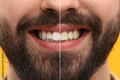 Man showing teeth before and after whitening on orange background  collage