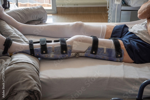 a man with a broken leg in an orthosis on a bed in a clinic after an accident and a fracture of the femur