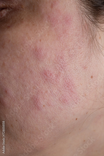 Red rash eczema on a woman face due to fat liver disease , close up texture