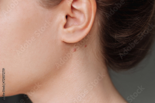 Cropped shot of young woman with the problem of acne. Pimples on the neck under the ear. Allergies, dermatitis, hormonal changes. Problem skin, care and beauty concept. Dermatology, cosmetology