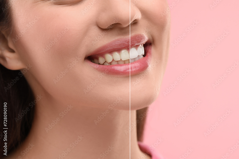 Woman showing teeth before and after whitening on pink background, collage