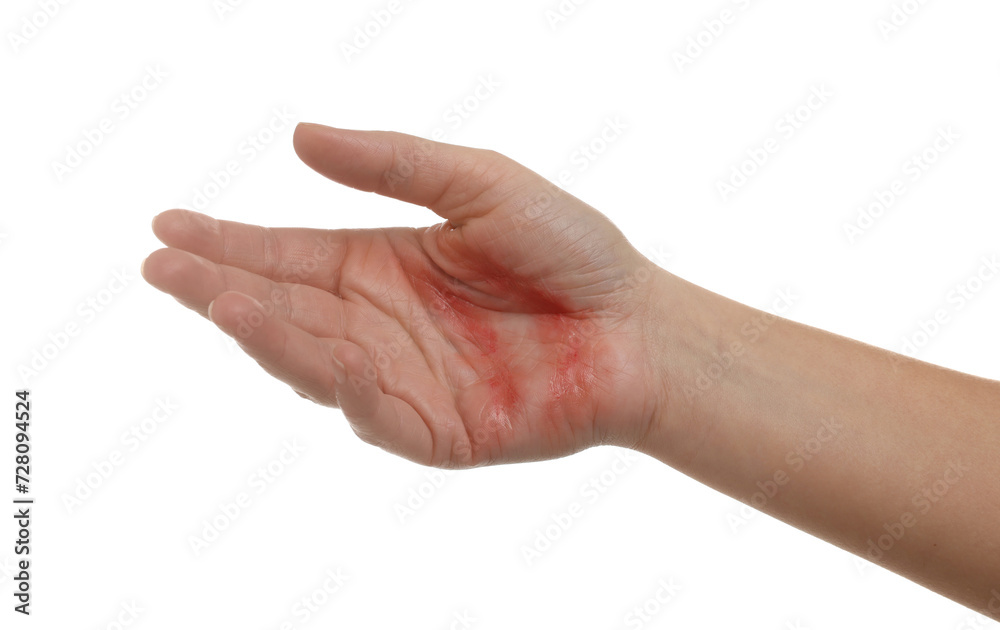 Woman with burned hand on white background, closeup Woman with burned hand on white background, closeup