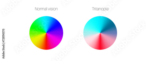 Tritanopia and tritanomaly