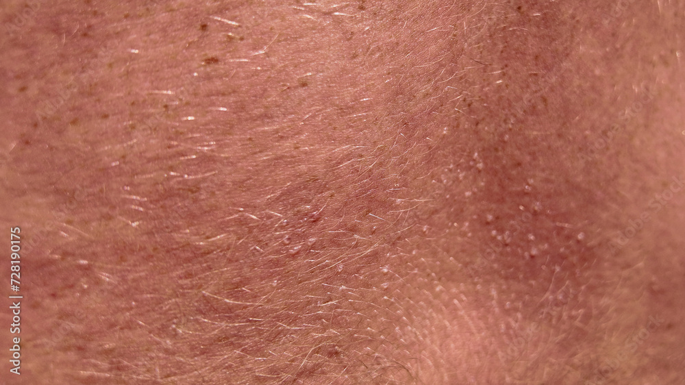 Fototapeta premium Close-up texture of human skin showing hair and sun allergy bubbles, suitable for health and dermatological concepts