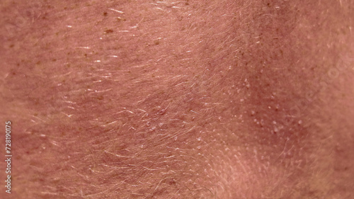 Close-up texture of human skin showing hair and sun allergy bubbles, suitable for health and dermatological concepts photo