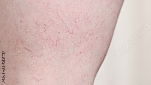 Close-up of woman's leg with red rash and vascular asterisks. Concept of varicosity and skin problem photo