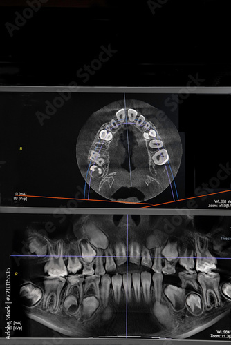 CT image of the teeth of a 9-year-old child, with baby teeth, in different projections. CBCT of two jaws.
