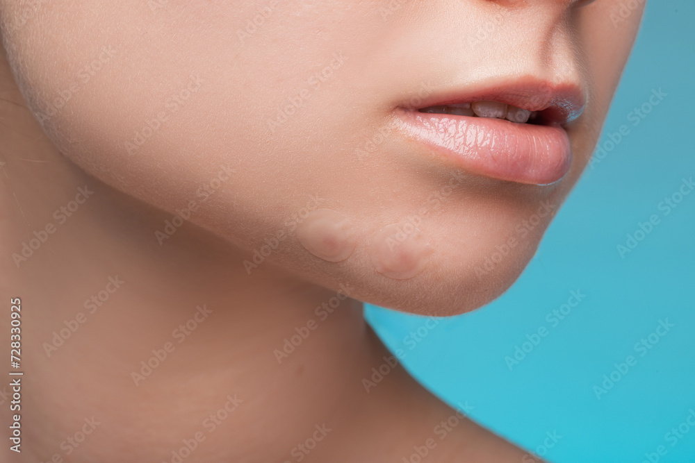 Girl with acne stick round acne patch on her cheek. Using acne patches for treatment of pimple and rosacea close-up. Facial rejuvenation cleansing cosmetology