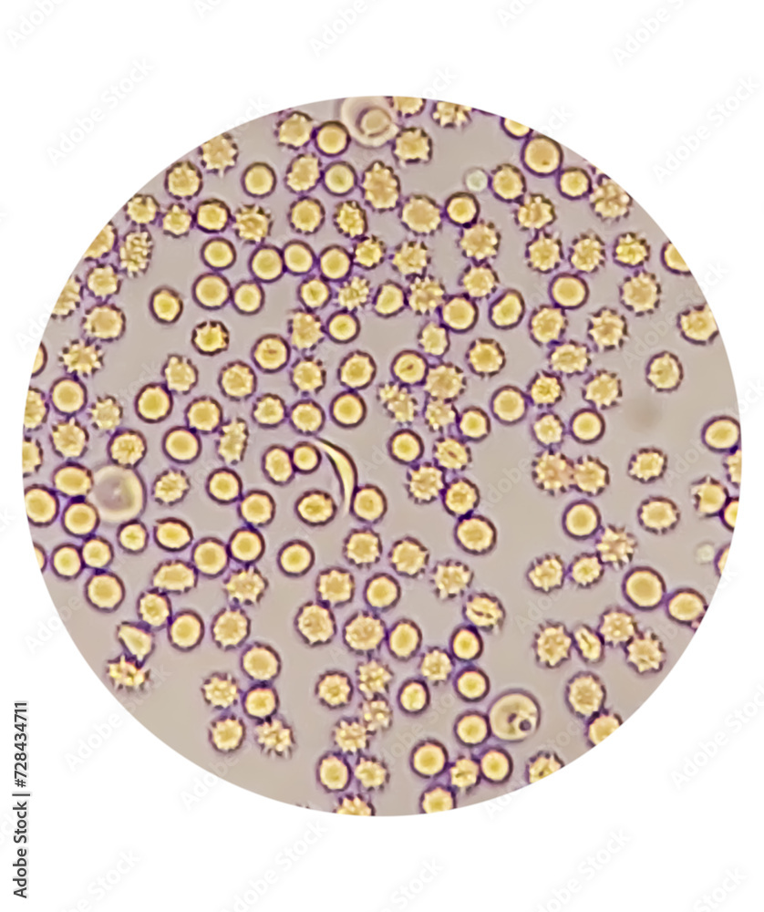Photomicrograph of Sickle cell anemia, sickling test. Sickle cell disease (SCD) Photomicrograph of Sickle cell anemia, sickling test. Sickle cell disease (SCD)