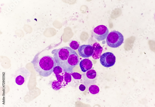 Microscopic view of bone marrow slide showing Multiple myeloma, a type of bone marrow cancer. photo
