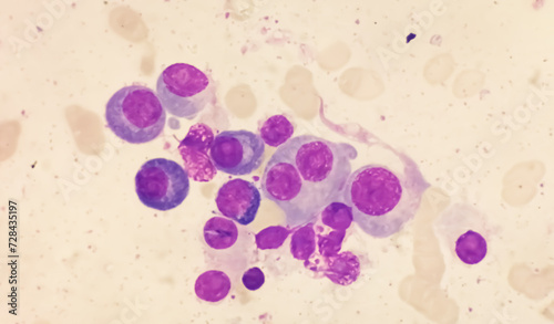 Microscopic view of bone marrow slide showing Multiple myeloma, a type of bone marrow cancer.