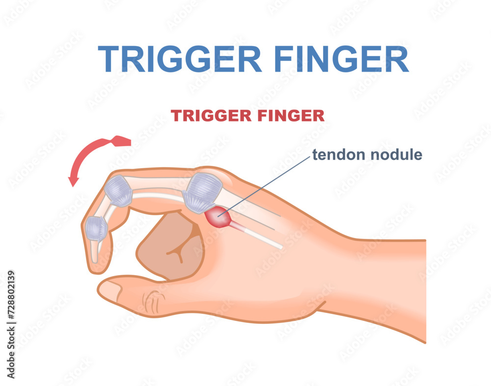 Trigger Fige Trigger finger concept. Medical infographics and educational materials ...