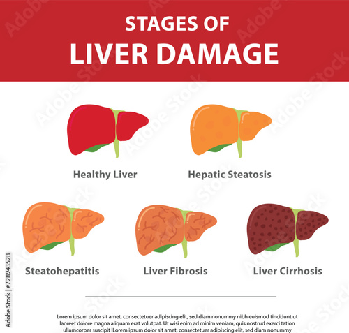 Stages of liver damage concept. Vector illustration of healthy liver, steatosis, NASH, fibrosis and cirrhosis. Flat vector illustration isolated on white background