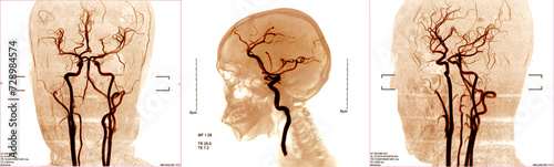 blood vessels x-ray images in the brain for diagnose cerebrovascular disease or hemorrhagic stroke. photo